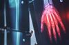 &quot;Enquête de santé&quot; : Mieux vivre avec l&#039;arthrose, mardi 10 juin 2025 sur France 5